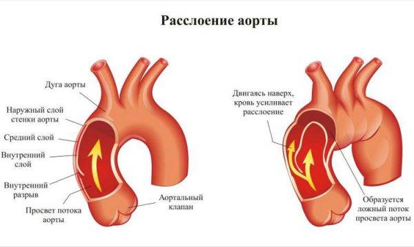 Расслаивающаяся аневризма аорты