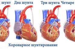 Схема коронарного шунтирования
