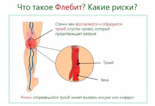 Флебит симптомы и лечение