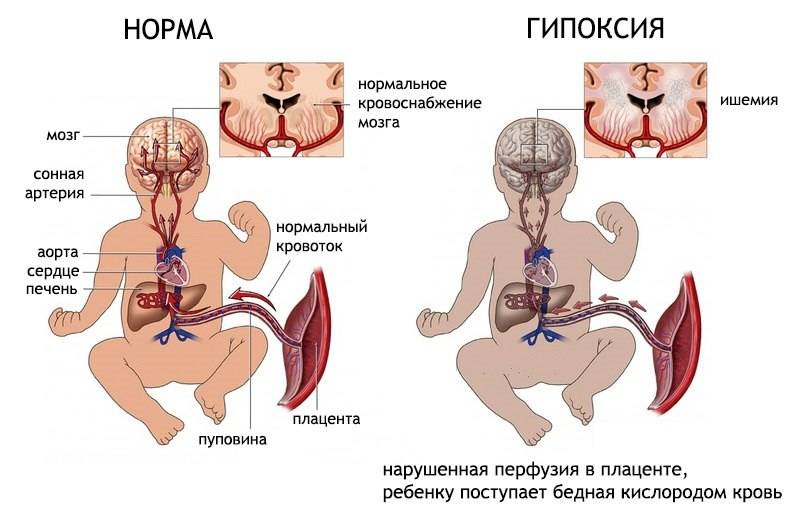Кислородное голодание сердца