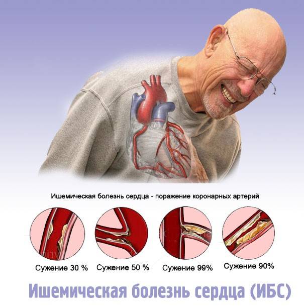 Кислородное голодание сердца