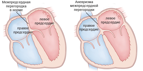 Межпредсердная перегородка в норме и с аневризмой