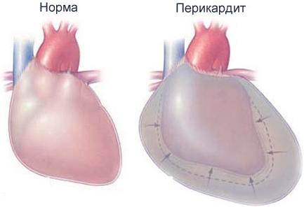 Перикардит