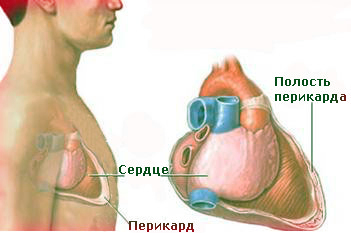 Лечение перикардита