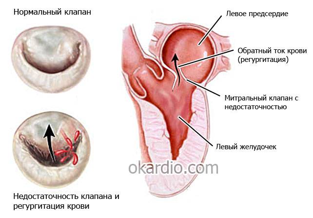 регургитация крови при недостаточности митрального клапана