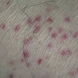 Васкулит