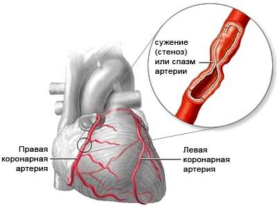 этиология стенокардии