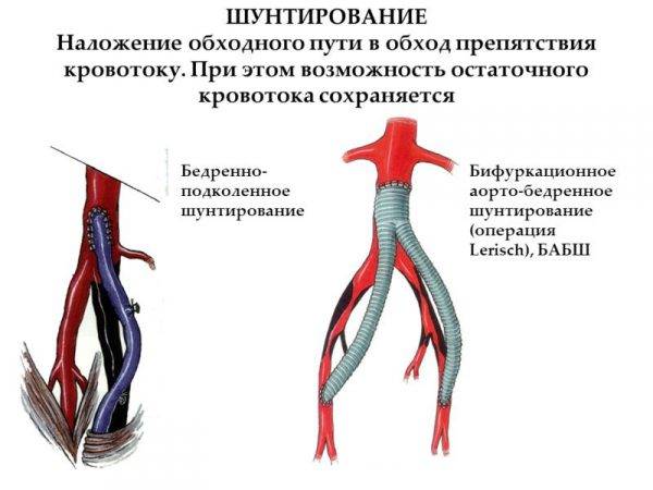 Бедренно-подколенное шунтирование