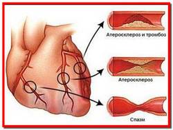Ишемическая болезнь сердца. Лечение народными средствами