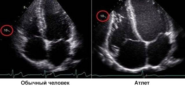 сравнение УЗИ сердца обычного человека и спортсмена-атлета