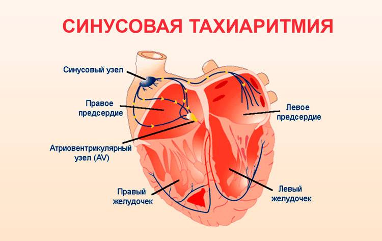 Синусовая тахиаритмия