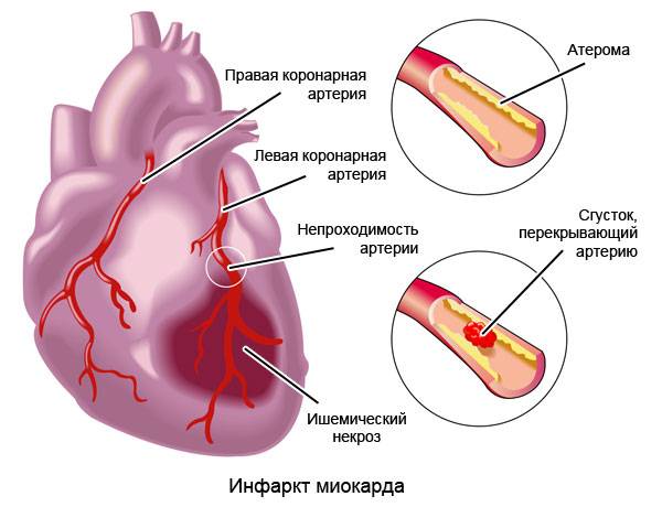 инфаркт миокарда – очаг ишемического некроза сердечной мышцы