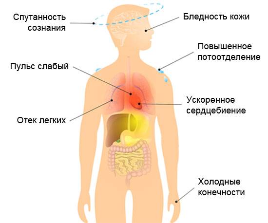 визуальные симптомы кардиогенного шока