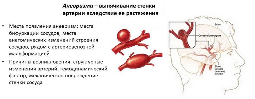 Аневризма головного мозга