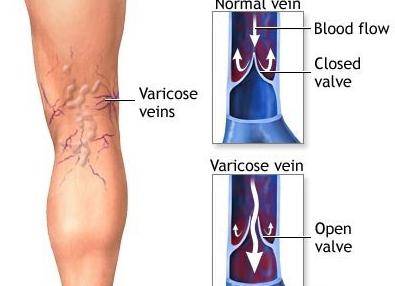 лекарства от варикоза