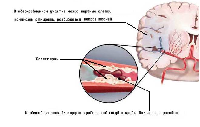 Причиной инсультов является холестерин в сосудах головного мозга
