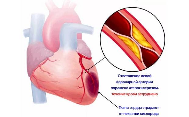 ИБС причины развития
