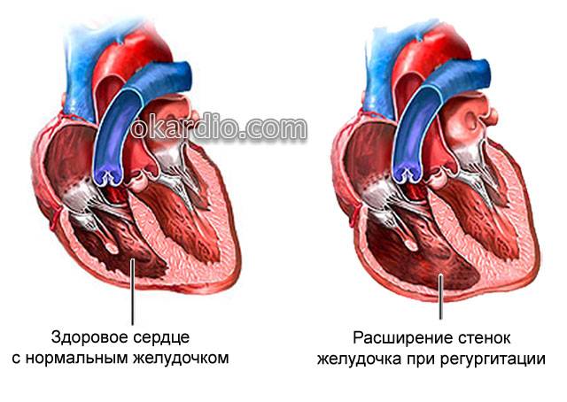 расширение желудочка из-за трикуспидальной регургитации