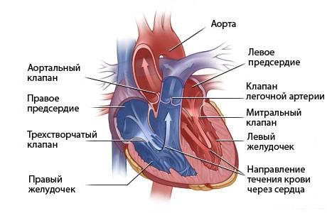 инфаркт