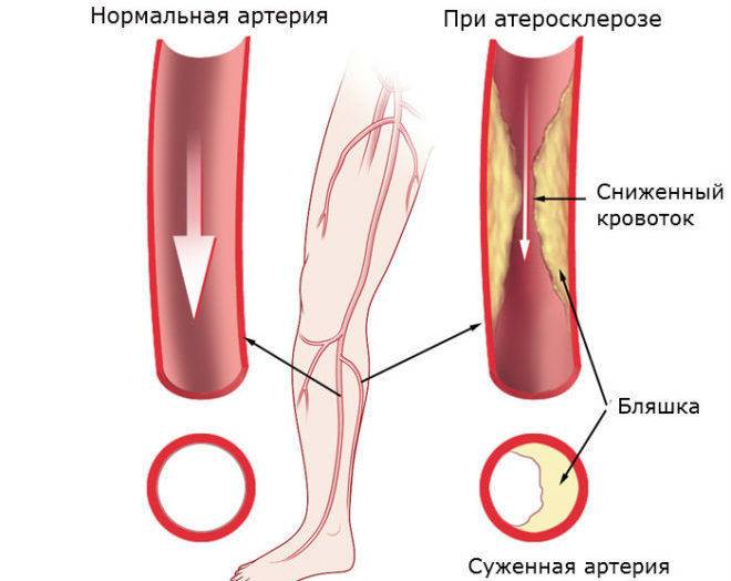 Атеросклероз