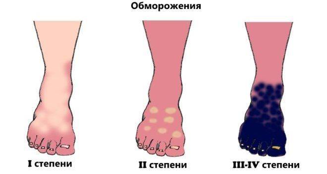 Обморожения