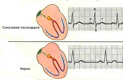 Тахикардия