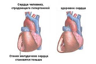 Сердце при гипертонии Сердце при гипертонии