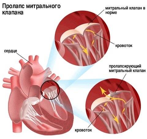 prolaps-mitralnogo-klapana