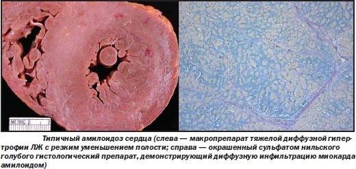 амилоидоз сердца