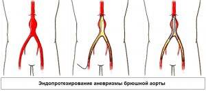 Лечение аневризмы проходит только хирургическим путем