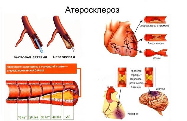 Атеросклероз