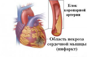 Закупорка коронарной артерии Закупорка коронарной артерии