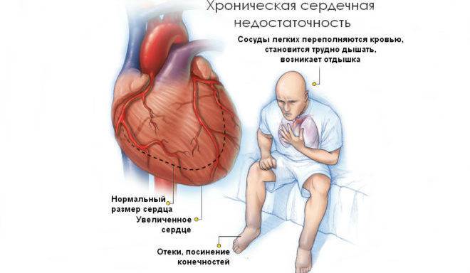 Сердечная недостаточность