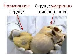 внешний вид сердца при алкогольной кардиомиапатии