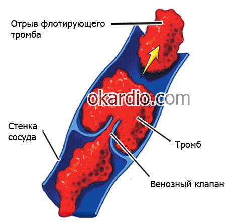 флотирующий тромб