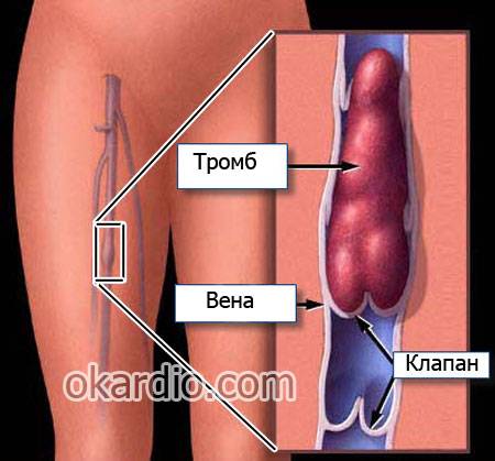 тромбофлебит глубоких вен