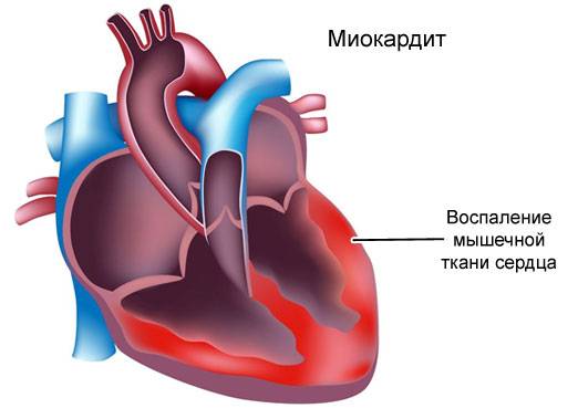 миокардит