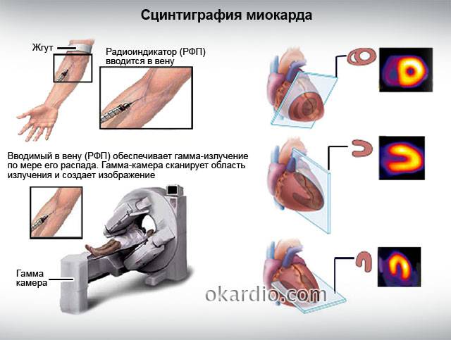 сцинтиграфия миокарда