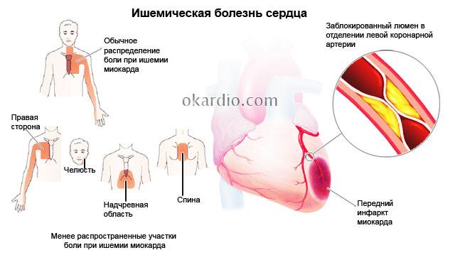 ишемическая болезнь сердца