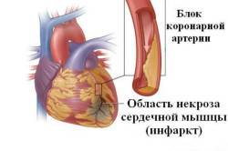 Инфаркт миокарда