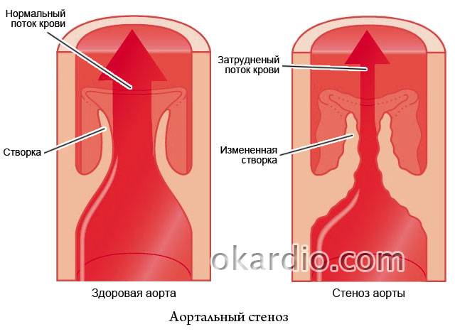 стеноз аорты