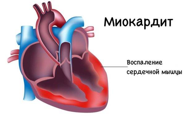 миокардит