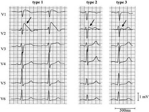 Синдром Бругада