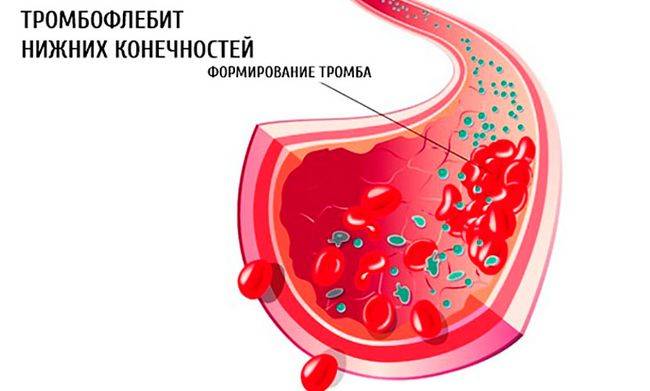 Тромбофлебит нижних конечностей - это заболевание, коорое приводит к серьёзным нарушениям вен и может потребовать врачебного вмешательства