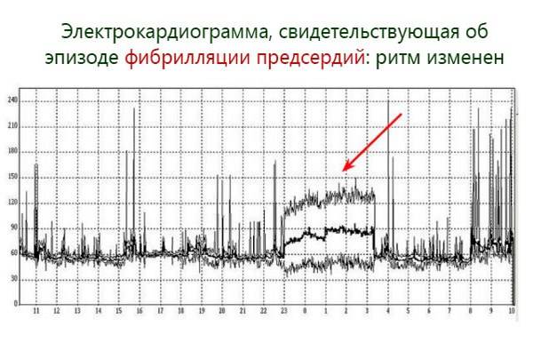 кардиограмма при фибрилляции