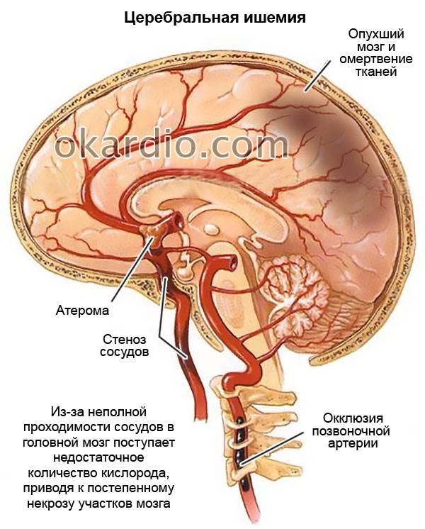 церебральная ишемия