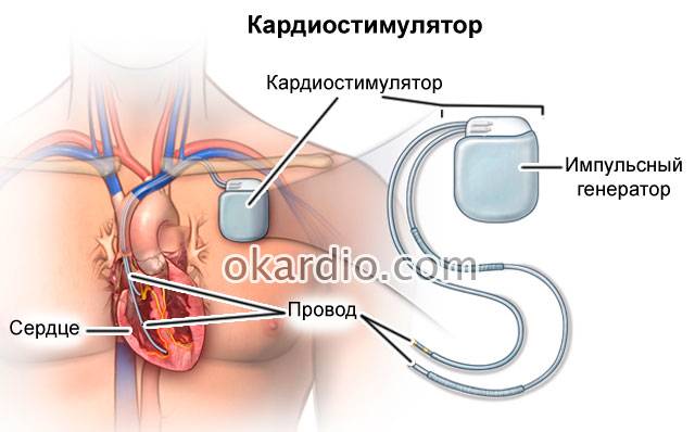 кардиостимулятор сердца