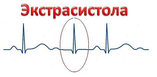 Экстрасистола