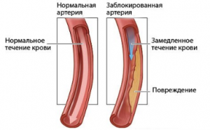 kalcinoz-sosuda-mozga