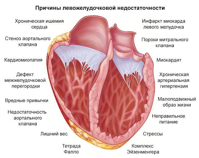 причины левожелудочковой недостаточности